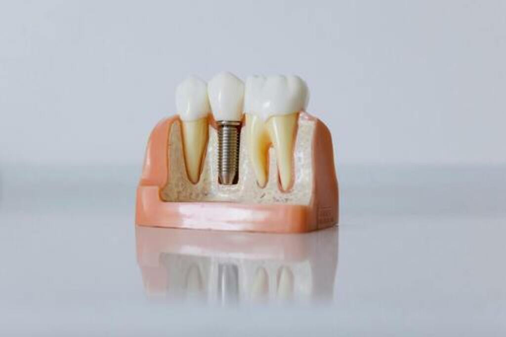 What is a Dental Implant?