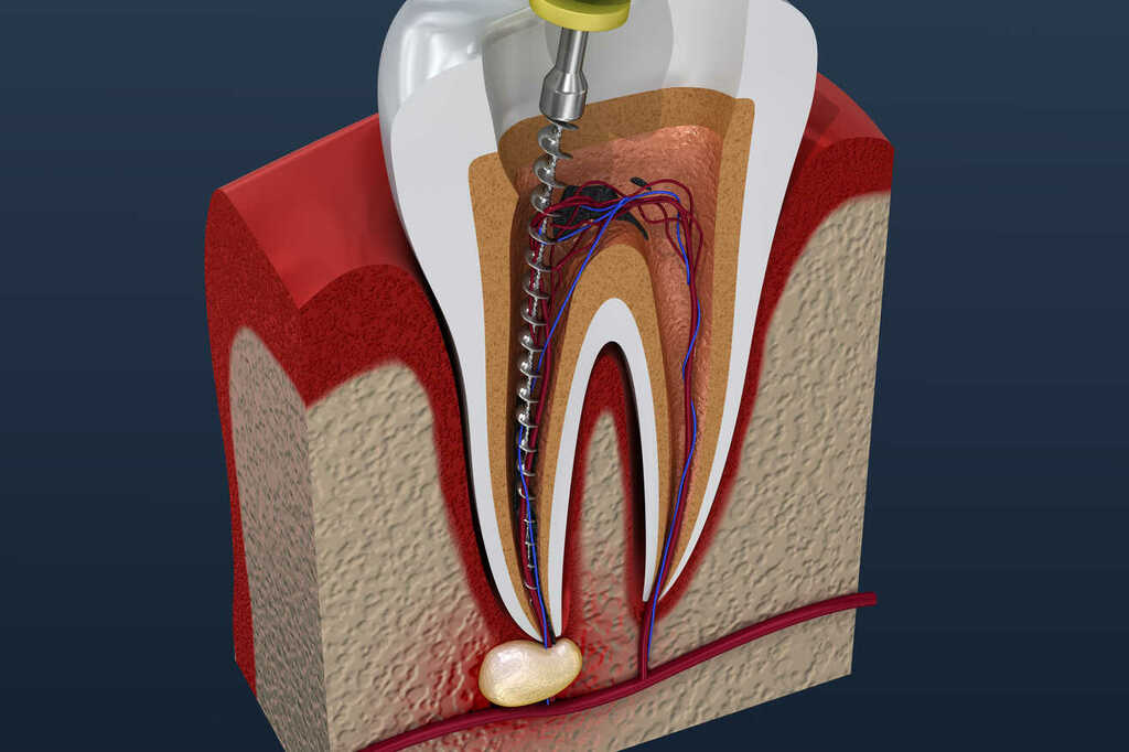 Root Canal Treatment at Shree Krishna Dental Care Bhubaneswar