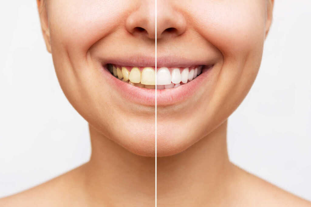 Teeth Whitening at Shree Krishna Dental Care Bhubaneswar