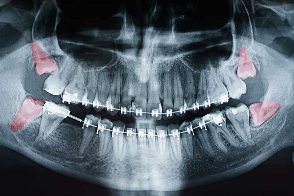 Wisdom Tooth Extraction at Shree Krishna Dental Care Bhubaneswar